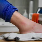 Allergie bas de contention : frottements à la cheville et peau irritée