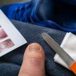 Ongle gros orteil qui jaunit : mycose ou frottements, vernis en cause